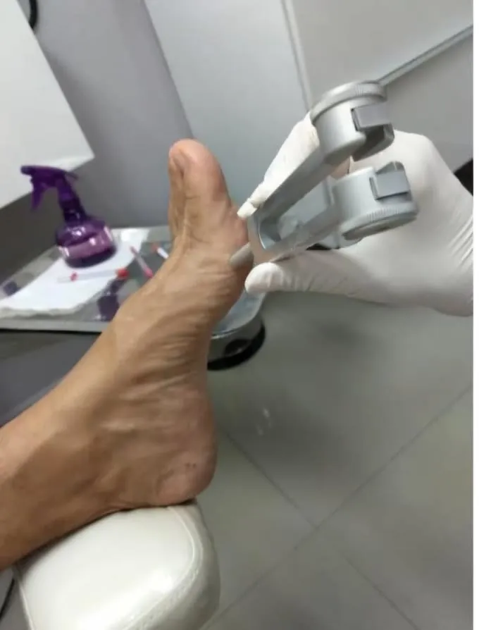 Diapasão apoiado no hálux para o teste de sensibilidade vibratória